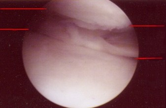 damaged meniscus